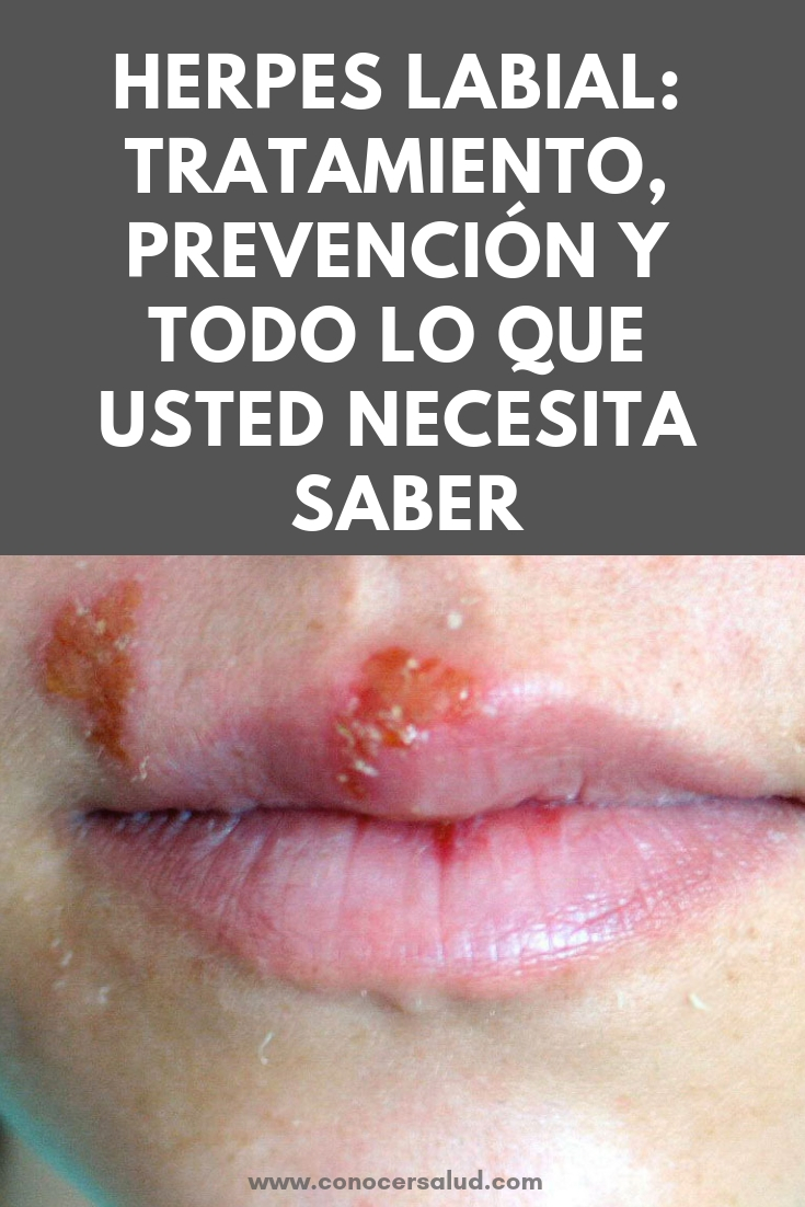 Herpes Labial Tratamiento Prevencion Y Todo Lo Que Usted Necesita Saber