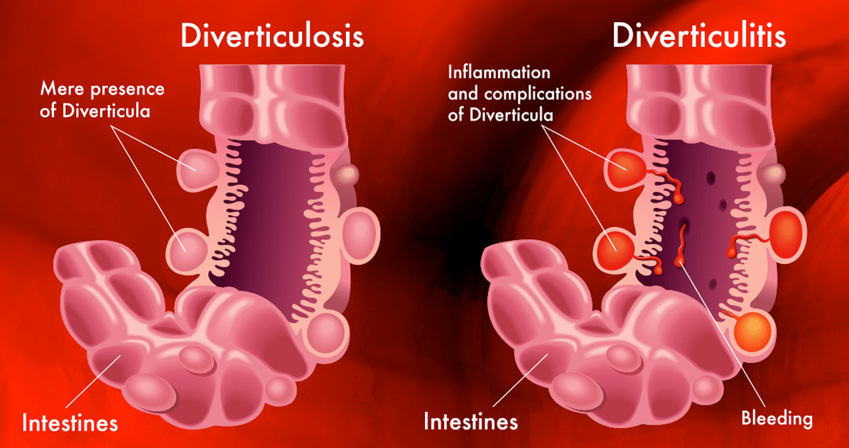 ¿qué Es La Diverticulitis Causas Síntomas Y Tratamientosemk 0661