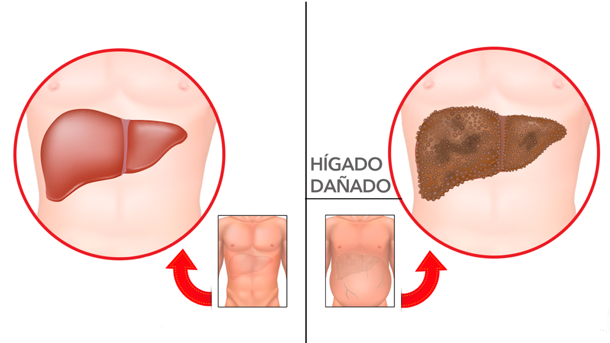 7 Advertencias Tempranas De Daño Hepático Que Nunca Debe Ignorar 8972