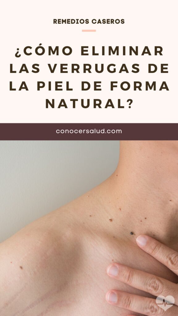 C Mo Eliminar Las Verrugas De La Piel De Forma Natural